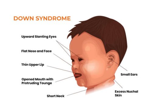 Down Syndrome Symptoms Down Syndrome Symptoms
